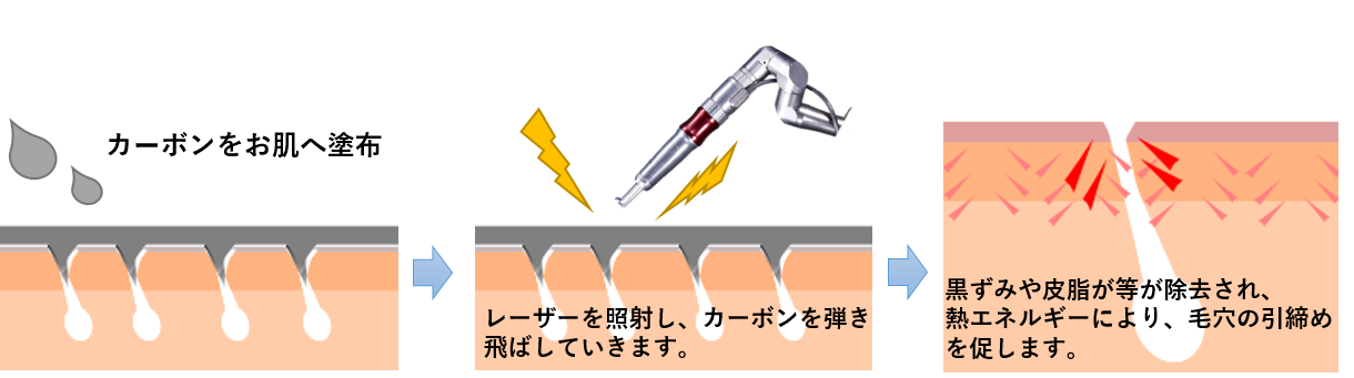 カーボンピーリング
